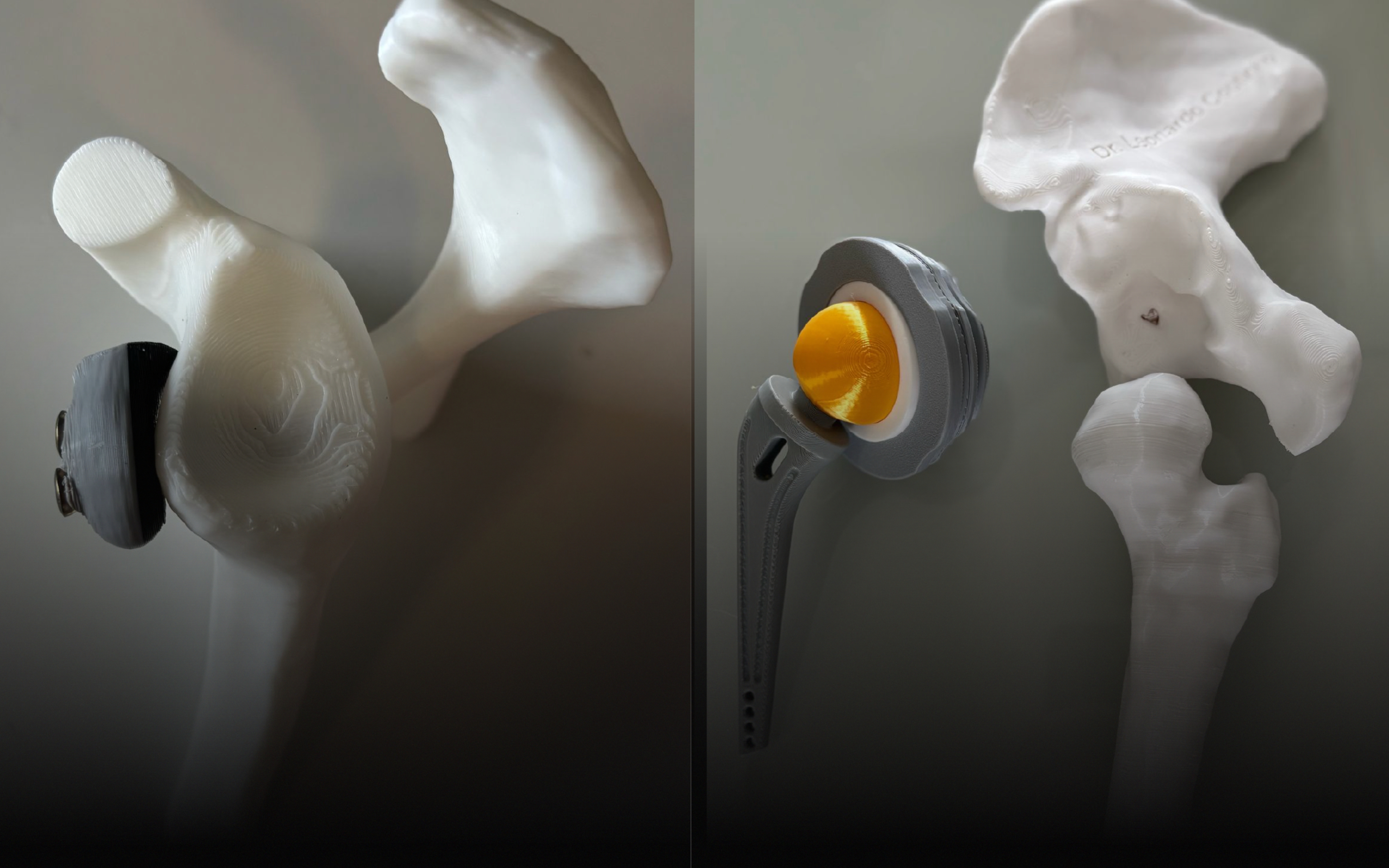 Como a Impressão 3D da Creality Está Revolucionando a Medicina no Brasil